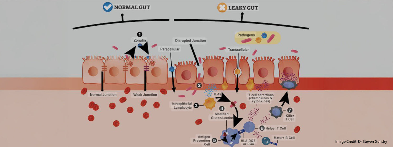 Leaky Gut: Why You're Bloated, Tired, and Over It (And How to Fix It)