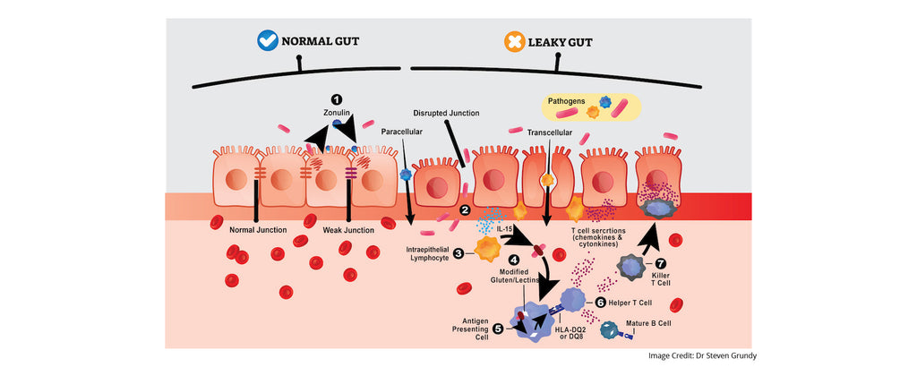 Leaky Gut: Why You're Bloated, Tired, and Over It (And How to Fix It)